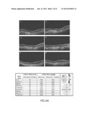 System and Method for Detection and Monitoring of Ocular Diseases and     Disorders using Optical Coherence  Tomography diagram and image