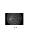 System and Method for Detection and Monitoring of Ocular Diseases and     Disorders using Optical Coherence  Tomography diagram and image