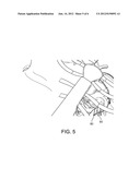 GUIDED PERCUTANEOUS BYPASS diagram and image