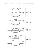 INFUSION SET diagram and image