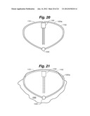 MEDICAL DEVICE FOR OCCLUDING A HEART DEFECT AND A METHOD OF MANUFACTURING     THE SAME diagram and image