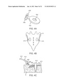 SACRAL TETHER ANCHOR AND METHODS OF USE diagram and image