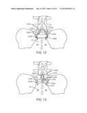 SACRAL TETHER ANCHOR AND METHODS OF USE diagram and image