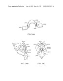 SACRAL TETHER ANCHOR AND METHODS OF USE diagram and image