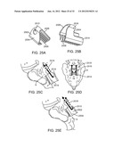 SACRAL TETHER ANCHOR AND METHODS OF USE diagram and image