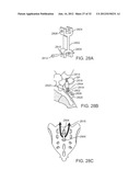 SACRAL TETHER ANCHOR AND METHODS OF USE diagram and image