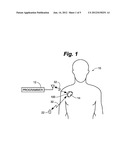 Implantable Medical Device for Treating Neurological Conditions Including     ECG Sensing diagram and image