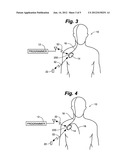 Implantable Medical Device for Treating Neurological Conditions Including     ECG Sensing diagram and image