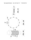 STENTS AND METHODS OF MAKING STENTS diagram and image