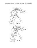 SOFT TISSUE REPAIR APPARATUS AND METHOD diagram and image