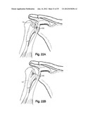 SOFT TISSUE REPAIR APPARATUS AND METHOD diagram and image