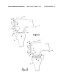 Pyrocarbon Orthopedic Implant diagram and image