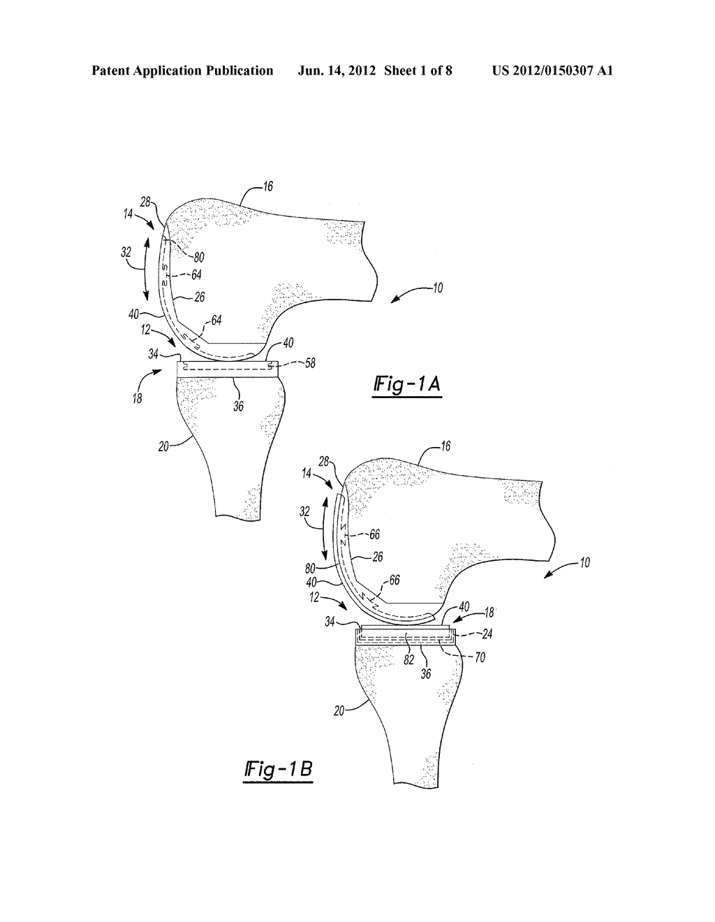 Pyrocarbon Orthopedic Implant - diagram, schematic, and image 02