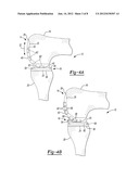 Pyrocarbon Orthopedic Implant diagram and image