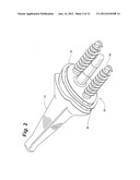 PROSTHETIC WRIST IMPLANT diagram and image