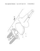 PROSTHETIC WRIST IMPLANT diagram and image