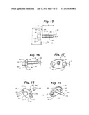 PROSTHETIC WRIST IMPLANT diagram and image