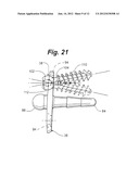 PROSTHETIC WRIST IMPLANT diagram and image