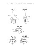 PROSTHETIC WRIST IMPLANT diagram and image