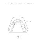 ORTHODONTIC ALIGNER FABRICATION BY OVERLAY METHOD diagram and image