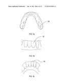 ORTHODONTIC ALIGNER FABRICATION BY OVERLAY METHOD diagram and image