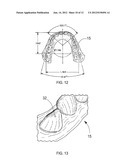 ORTHODONTIC ALIGNER FABRICATION BY OVERLAY METHOD diagram and image