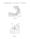 ORTHODONTIC ALIGNER FABRICATION BY OVERLAY METHOD diagram and image