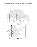 Ablative technique using compton scattered x-ray visualizing, imaging, or     information providing based on matter material density diagram and image