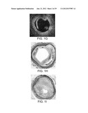 Selectable Eccentric Remodeling and/or Ablation of Atherosclerotic     Material diagram and image