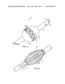 Selectable Eccentric Remodeling and/or Ablation of Atherosclerotic     Material diagram and image