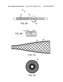 Selectable Eccentric Remodeling and/or Ablation of Atherosclerotic     Material diagram and image