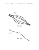 Selectable Eccentric Remodeling and/or Ablation of Atherosclerotic     Material diagram and image