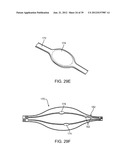 Selectable Eccentric Remodeling and/or Ablation of Atherosclerotic     Material diagram and image