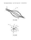 Selectable Eccentric Remodeling and/or Ablation of Atherosclerotic     Material diagram and image