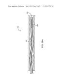 Selectable Eccentric Remodeling and/or Ablation of Atherosclerotic     Material diagram and image