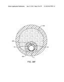 Selectable Eccentric Remodeling and/or Ablation of Atherosclerotic     Material diagram and image