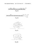 Expandable Implant and Implant System diagram and image