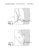 APPARATUS AND METHOD FOR DRIVING A HEMORRHAGE OCCLUDER PIN INTO A HUMAN     SACRUM diagram and image