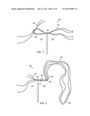 RE-TENSIONABLE KNOTLESS SUTURE SYSTEM diagram and image