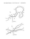RE-TENSIONABLE KNOTLESS SUTURE SYSTEM diagram and image