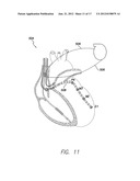 SYSTEMS AND METHODS FOR ASSESSING THE SPHERICITY AND DIMENSIONAL EXTENT OF     HEART CHAMBERS FOR USE WITH AN IMPLANTABLE MEDICAL DEVICE diagram and image