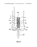 SYSTEMS AND METHODS FOR POSITIONING A HEART VALVE USING VISUAL MARKERS diagram and image