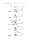 SURGICAL DRILL GUIDE AND INDEX SYSTEM diagram and image