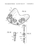 SURGICAL DRILL GUIDE AND INDEX SYSTEM diagram and image