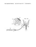 DENTAL IMPLEMENT HAVING LUMEN AND DISTAL THREADING diagram and image