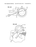 DISSECTION HANDPIECE WITH ASPIRATION MEANS FOR REDUCING THE APPEARANCE OF     CELLULITE diagram and image