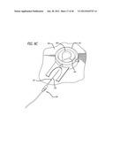 DISSECTION HANDPIECE WITH ASPIRATION MEANS FOR REDUCING THE APPEARANCE OF     CELLULITE diagram and image