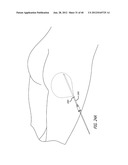 DISSECTION HANDPIECE WITH ASPIRATION MEANS FOR REDUCING THE APPEARANCE OF     CELLULITE diagram and image