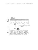 DISSECTION HANDPIECE WITH ASPIRATION MEANS FOR REDUCING THE APPEARANCE OF     CELLULITE diagram and image