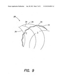 METHODS OF USING A CATHETER HAVING A BRAIDED CONDUCTIVE MEMBER diagram and image